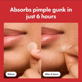 Acne Cover Patch